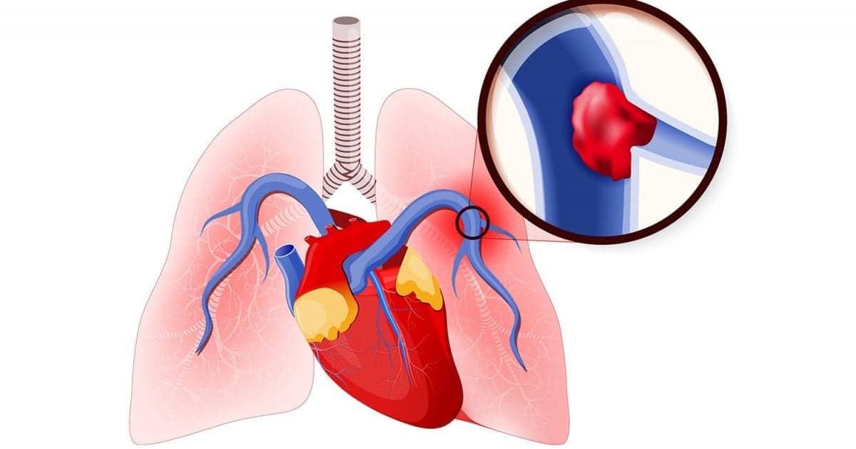 Unexplained Dyspnea May Indicate Pulmonary Embolism | RT dvt diagram 