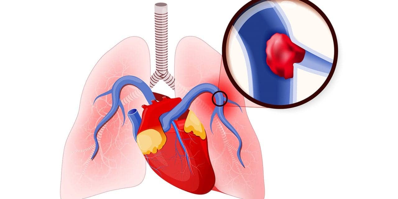 The embolus lodged in the pulmonary artery.